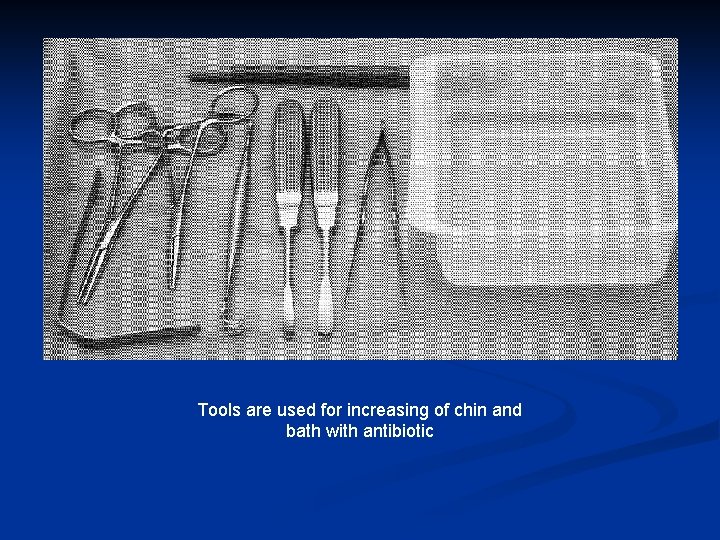 Tools are used for increasing of chin and bath with antibiotic 