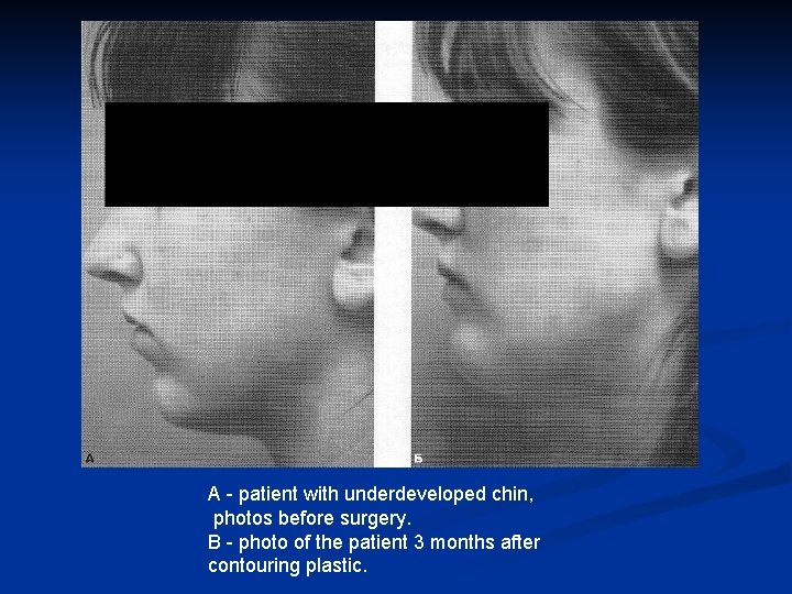 A - patient with underdeveloped chin, photos before surgery. B - photo of the