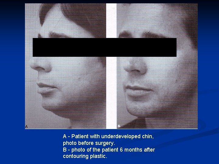 A - Patient with underdeveloped chin, photo before surgery. B - photo of the