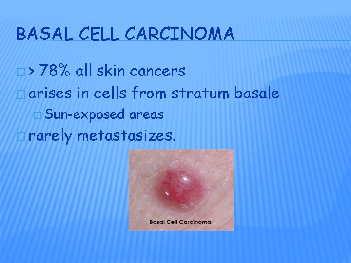 BASAL CELL CARCINOMA �> 78% all skin cancers � arises in cells from stratum