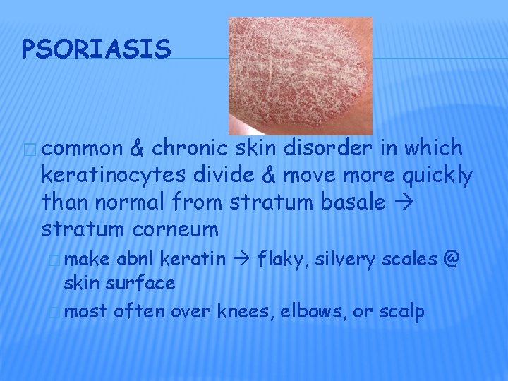 PSORIASIS � common & chronic skin disorder in which keratinocytes divide & move more