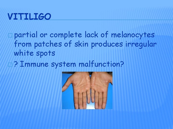 VITILIGO � partial or complete lack of melanocytes from patches of skin produces irregular VITILIGO � partial or complete lack of melanocytes from patches of skin produces irregular