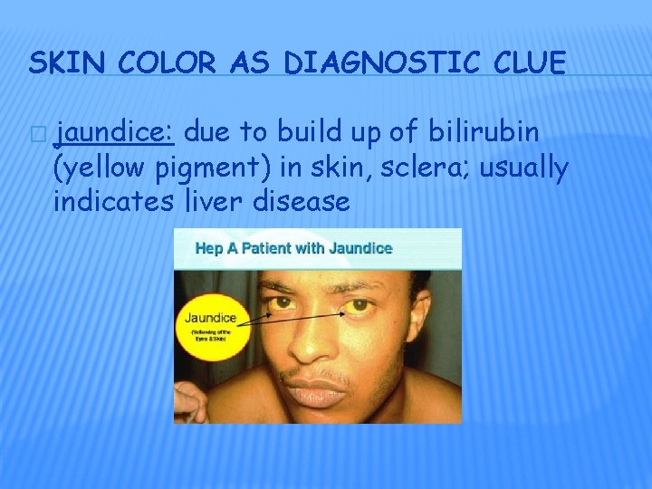 SKIN COLOR AS DIAGNOSTIC CLUE � jaundice: due to build up of bilirubin (yellow