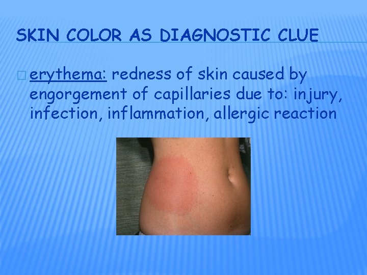 SKIN COLOR AS DIAGNOSTIC CLUE � erythema: redness of skin caused by engorgement of