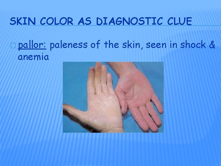 SKIN COLOR AS DIAGNOSTIC CLUE � pallor: anemia paleness of the skin, seen in