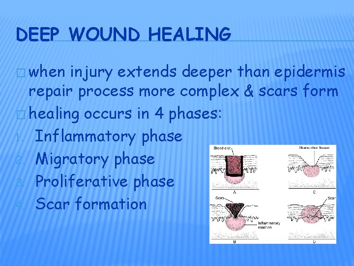 DEEP WOUND HEALING � when injury extends deeper than epidermis repair process more complex