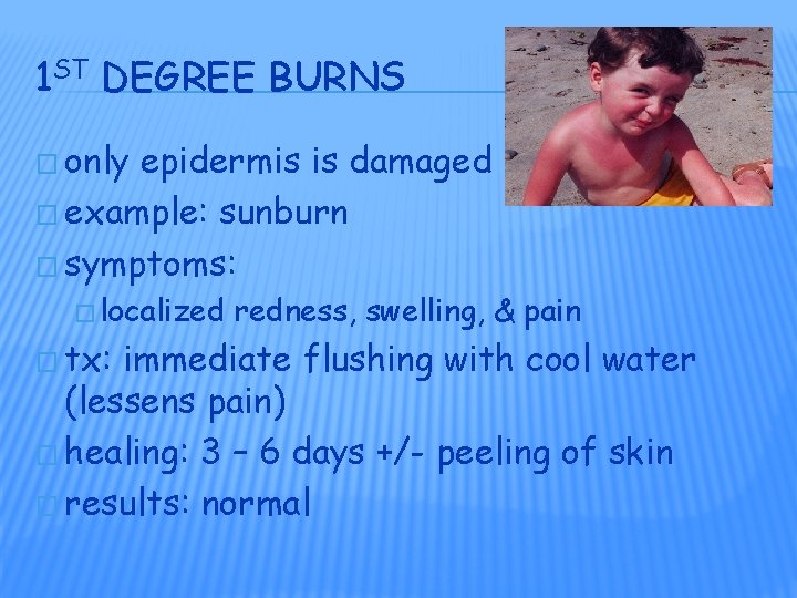 1 ST DEGREE BURNS � only epidermis is damaged � example: sunburn � symptoms: