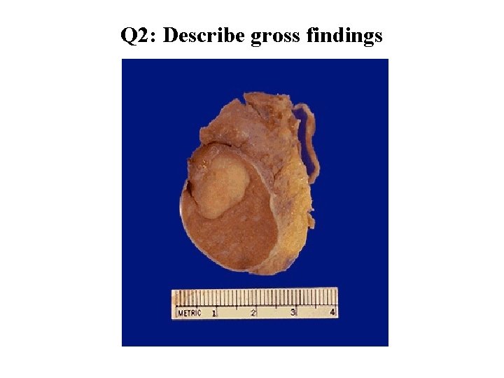Q 2: Describe gross findings 
