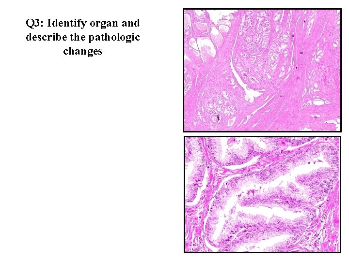 Q 3: Identify organ and describe the pathologic changes 