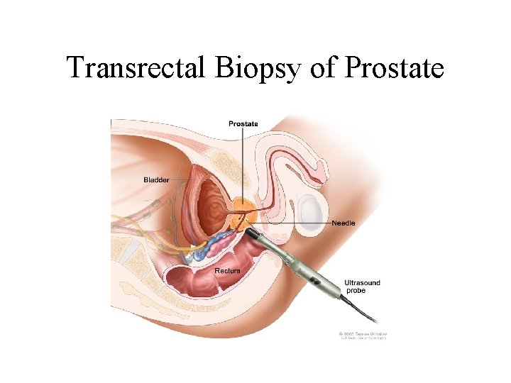 Transrectal Biopsy of Prostate 