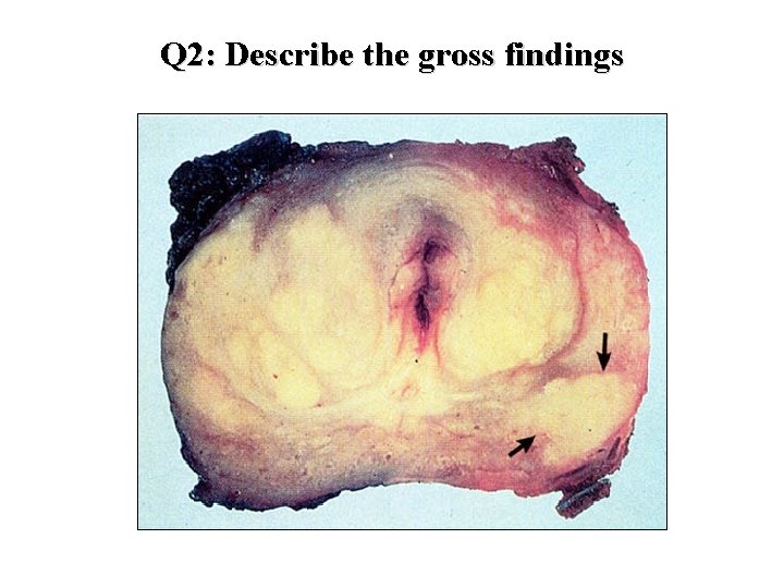 Q 2: Describe the gross findings 