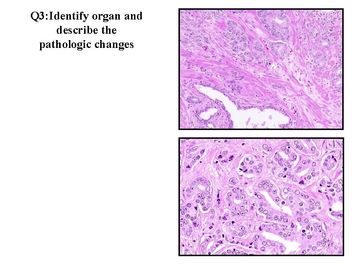 Q 3: Identify organ and describe the pathologic changes Q 3: Identify organ and describe the pathologic changes