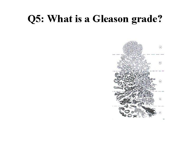 Q 5: What is a Gleason grade? 