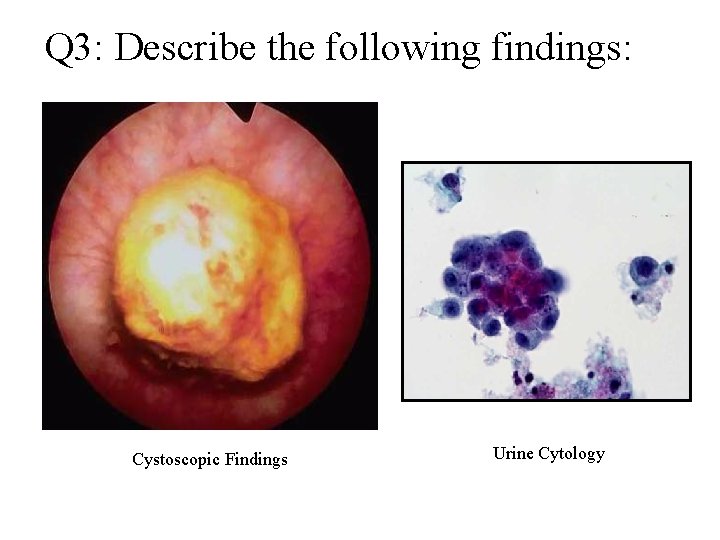 Q 3: Describe the following findings: Cystoscopic Findings Urine Cytology 