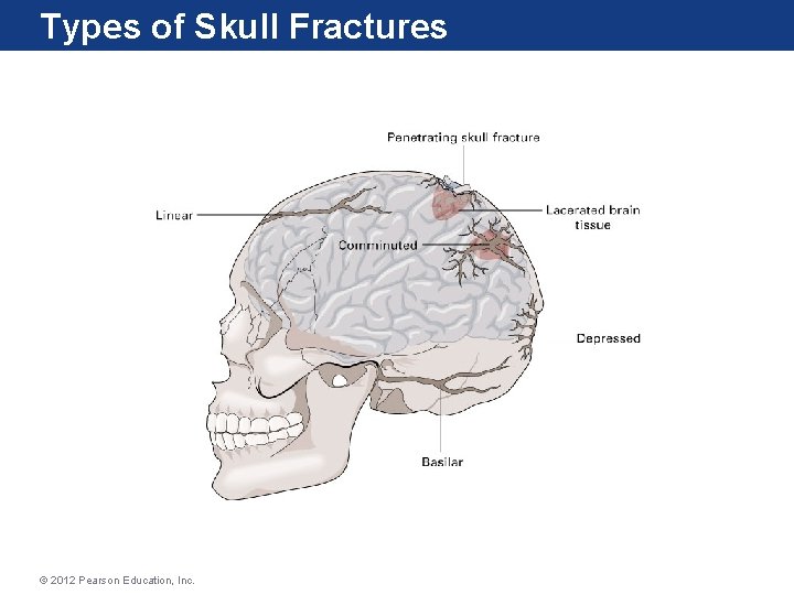 Types of Skull Fractures © 2012 Pearson Education, Inc. 