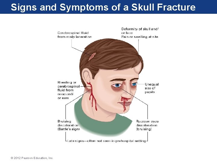 Signs and Symptoms of a Skull Fracture © 2012 Pearson Education, Inc. 