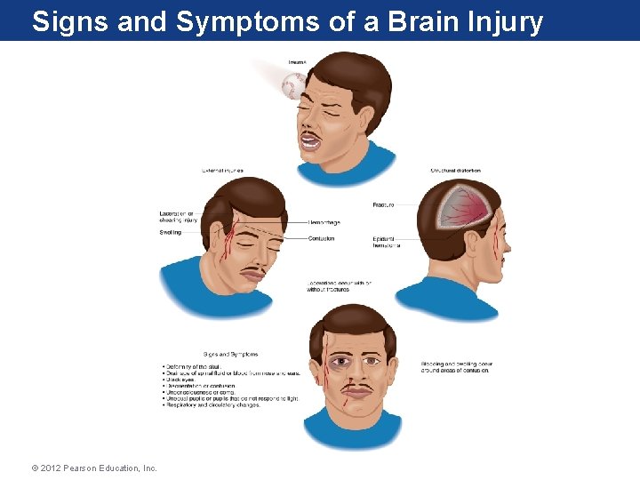 Signs and Symptoms of a Brain Injury © 2012 Pearson Education, Inc. 