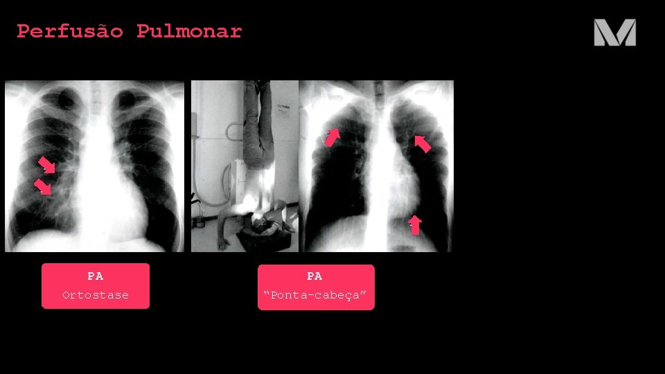Perfusão Pulmonar PA Ortostase PA “Ponta-cabeça” 