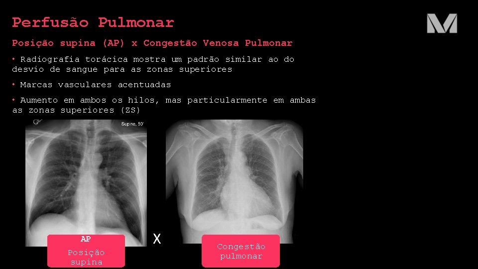 Perfusão Pulmonar Posição supina (AP) x Congestão Venosa Pulmonar • Radiografia torácica mostra um