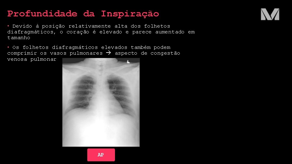 Profundidade da Inspiração • Devido à posição relativamente alta dos folhetos diafragmáticos, o coração