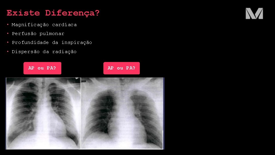 Existe Diferença? • Magnificação cardíaca • Perfusão pulmonar • Profundidade da inspiração • Dispersão