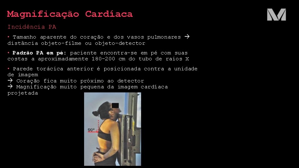 Magnificação Cardíaca Incidência PA • Tamanho aparente do coração e dos vasos pulmonares distância