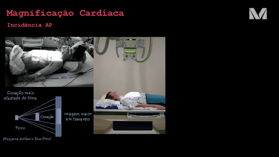Magnificação Cardíaca Incidência AP 