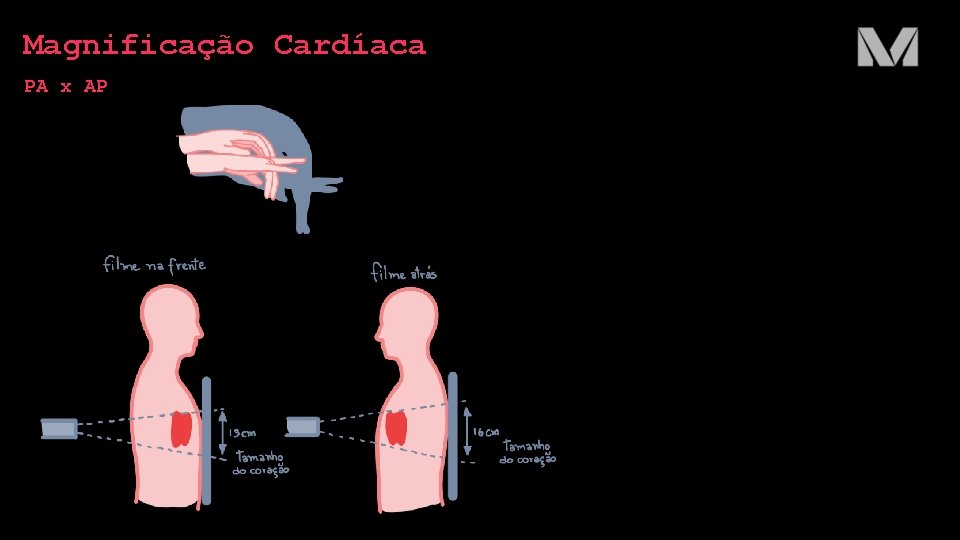 Magnificação Cardíaca PA x AP 