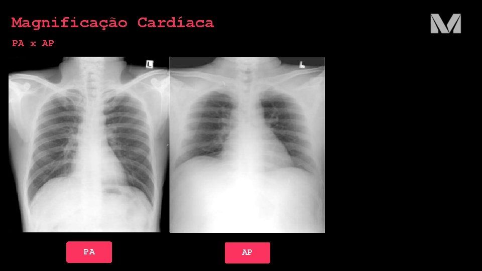 Magnificação Cardíaca PA x AP PA AP 