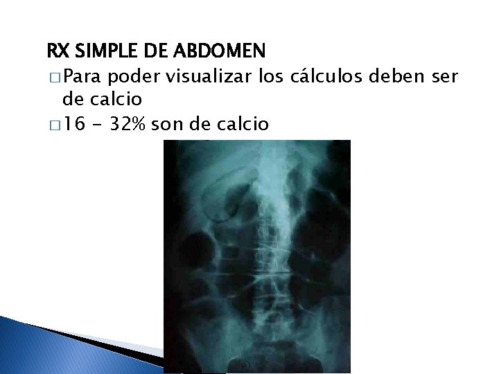 RX SIMPLE DE ABDOMEN � Para poder visualizar los cálculos deben ser de calcio