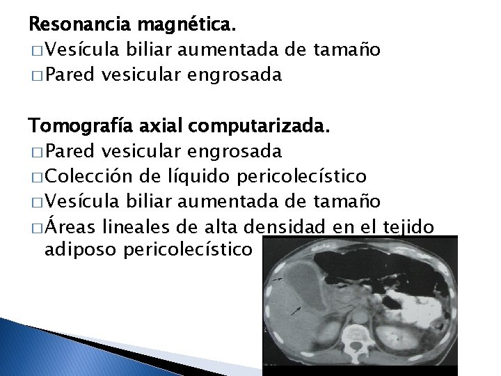 Resonancia magnética. � Vesícula biliar aumentada de tamaño � Pared vesicular engrosada Tomografía axial