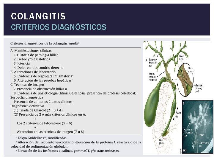 COLANGITIS CRITERIOS DIAGNÓSTICOS 