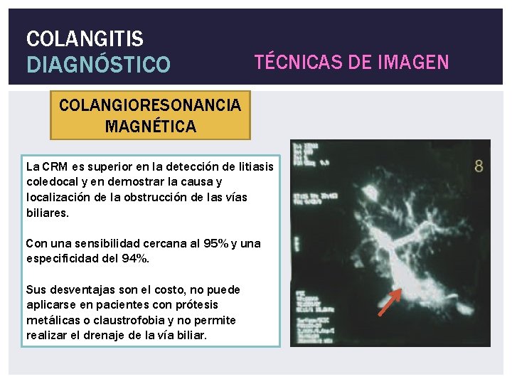 COLANGITIS DIAGNÓSTICO TÉCNICAS DE IMAGEN COLANGIORESONANCIA MAGNÉTICA La CRM es superior en la detección