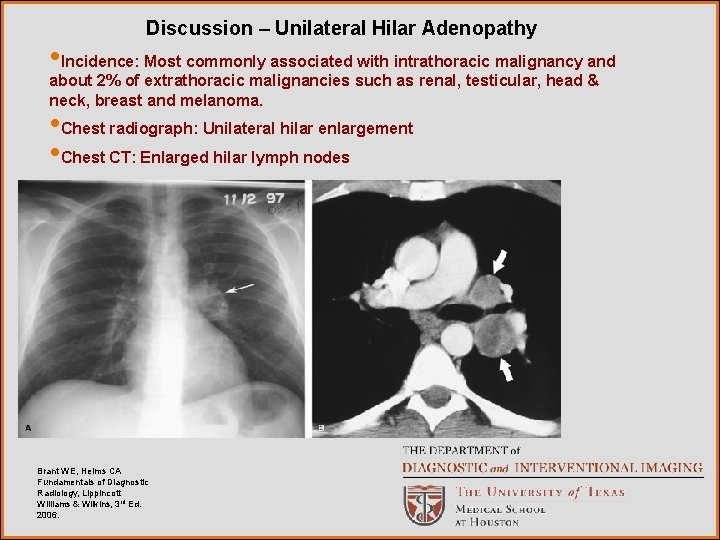 Discussion – Unilateral Hilar Adenopathy • Incidence: Most commonly associated with intrathoracic malignancy and