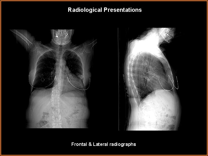 Radiological Presentations Frontal & Lateral radiographs 