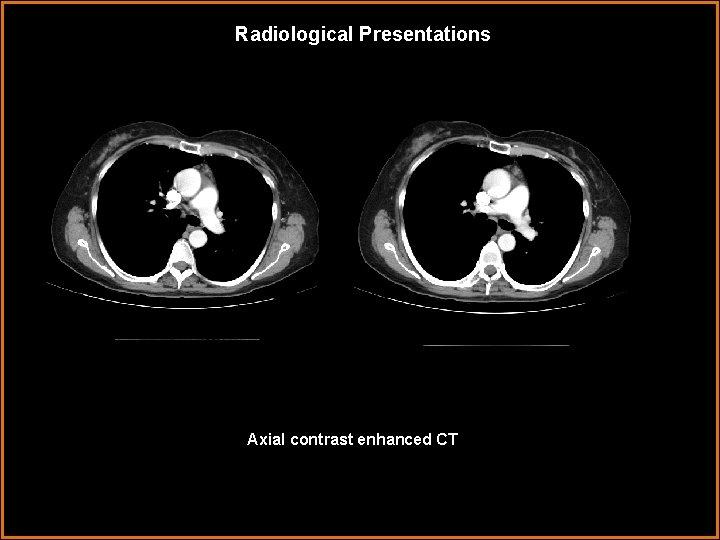 Radiological Presentations Axial contrast enhanced CT 