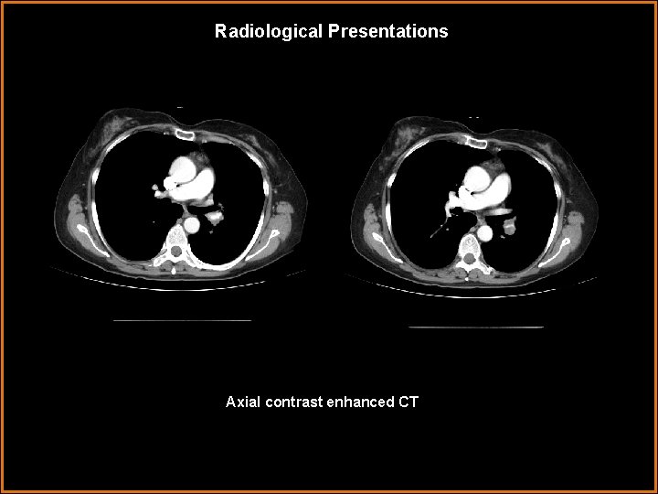 Radiological Presentations Axial contrast enhanced CT 