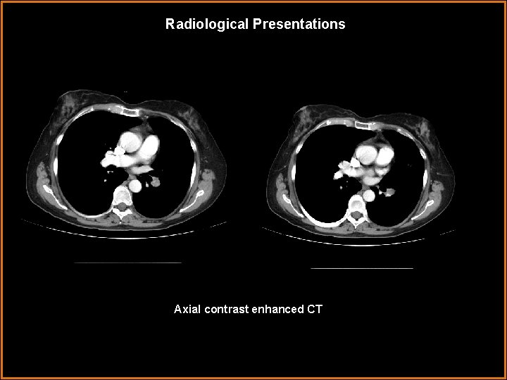 Radiological Presentations Axial contrast enhanced CT 