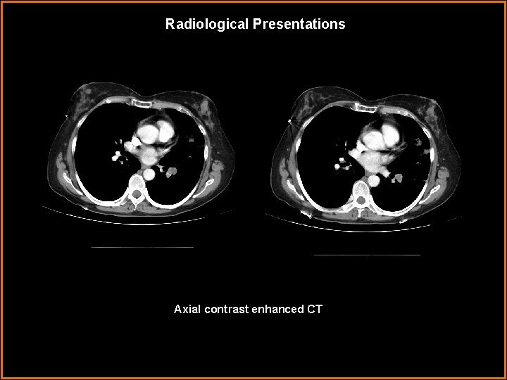 Radiological Presentations Axial contrast enhanced CT 