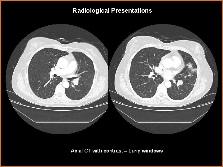 Radiological Presentations Axial CT with contrast – Lung windows 