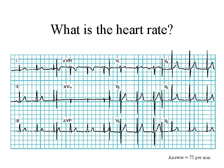 What is the heart rate? Answer = 75 per min 