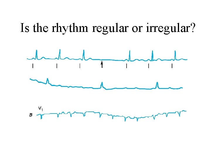 Is the rhythm regular or irregular? 
