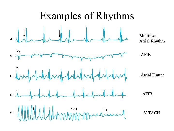 Examples of Rhythms Multifocal Atrial Rhythm AFIB Atrial Flutter AFIB V TACH 