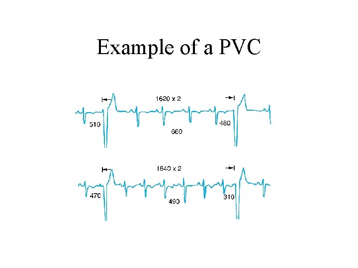 Example of a PVC 
