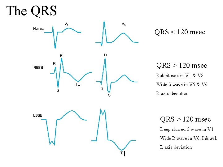 The QRS < 120 msec QRS > 120 msec Rabbit ears in V 1