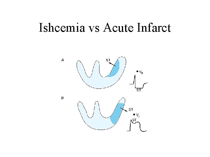 Ishcemia vs Acute Infarct 