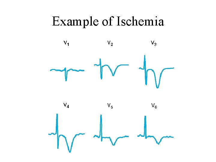 Example of Ischemia 