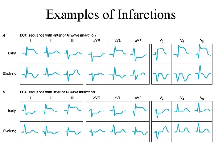Examples of Infarctions 