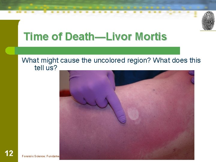 Time of Death—Livor Mortis What might cause the uncolored region? What does this tell