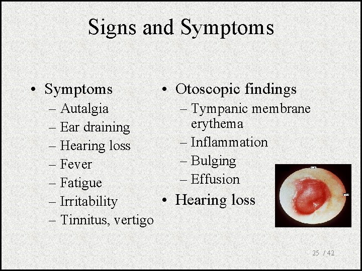 Signs and Symptoms • Symptoms • Otoscopic findings – Autalgia – Ear draining –